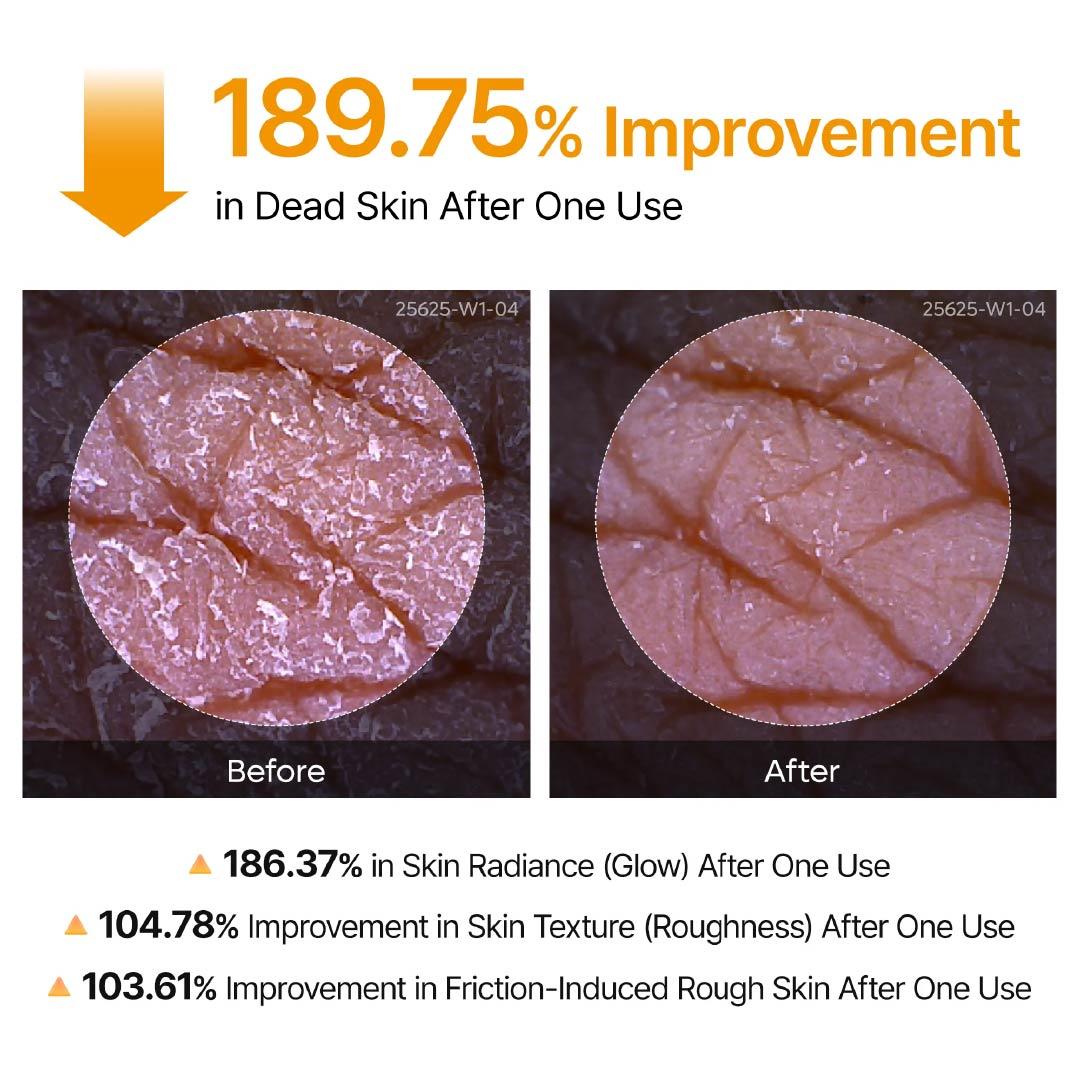 🥰Softiding Keratin Care Kojic Acid Turmeric Spray 200ml Pore Clearing Exfoliating Formula Skin Repair Scrub(Buy three, get one free)